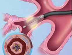 Bronchial Thermoplasty