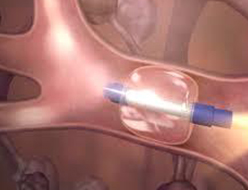 Bronchoscopic Thermal Vapour Ablation