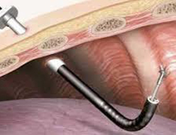 Medical Thoracoscopy